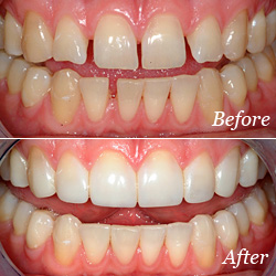 Dental Before and After Pictures Silver Spring & Germantown, MD