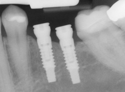 Dental Implants in Silver Spring & Germantown, MD