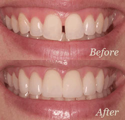 Dental Before and After Pictures Silver Spring & Germantown, MD
