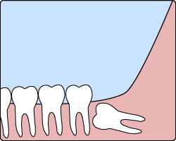 Wisdom Tooth Extraction in Silver Spring & Germantown, MD